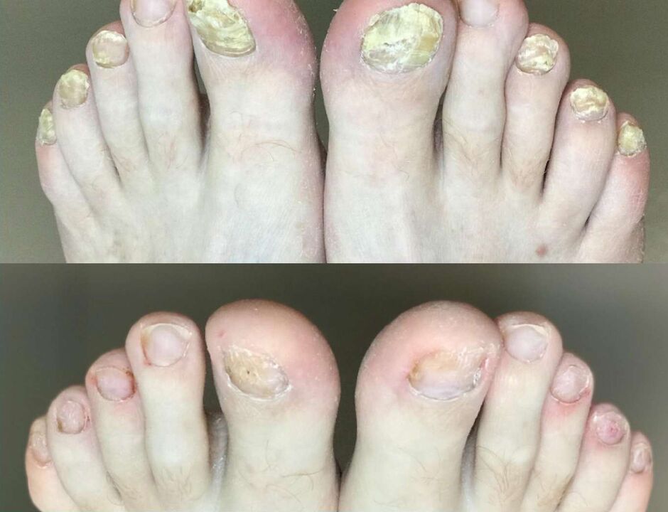 Before and after treatment, the fungus Promisil cream