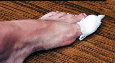 Compresses for treating the fungus on the thumb of the leg