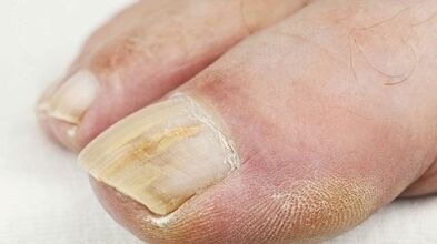The reasons for the appearance of the fungus on the thumb of the leg