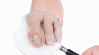 how to treat a fungus on the thumb of the leg