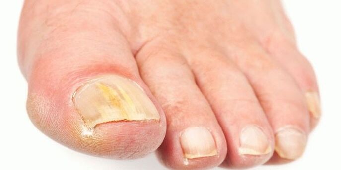 Effective products from nail fungus