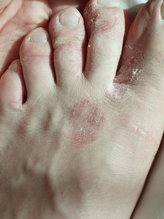 fungus between toes